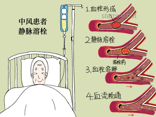 网红健康风险上升，急性脑梗年轻化趋势预警